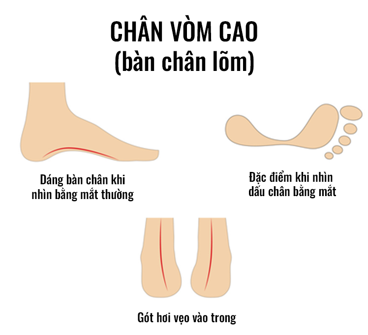 Kiểu chân: Chân vòm cao