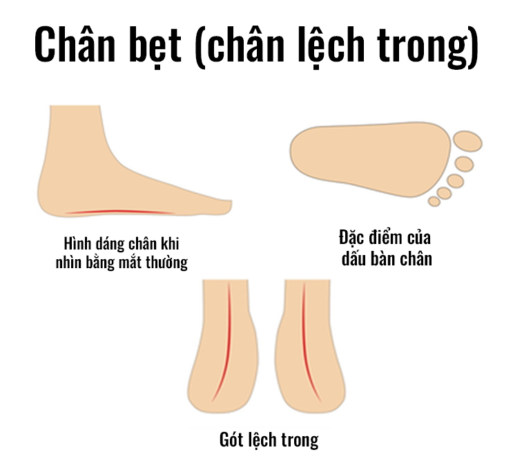 Chân bẹt (Chân lệch trong)